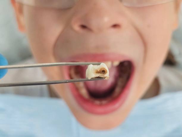 Best Emergency Treatment for Dental Infections or Abscesses in Highland, IN